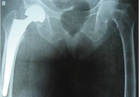 Thay khớp háng do gãy cổ xương đùi ở người cao tuổi: lợi ích và nguy cơ