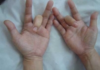 Hội chứng “ngón tay bật” là gì? 