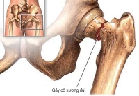 Thay khớp háng ở người cao tuổi - Giải pháp khi bị gãy cổ xương đùi 